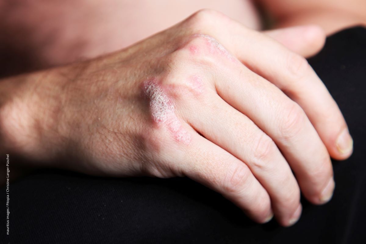 Eine Hand mit typischen Hautveränderungen bei Psoriasis.