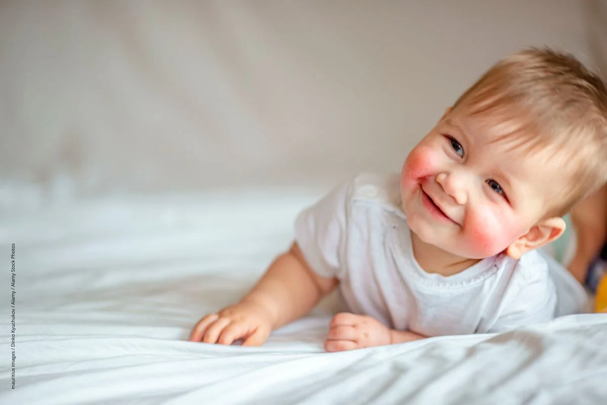 Das hilft Kindern mit Neurodermitis