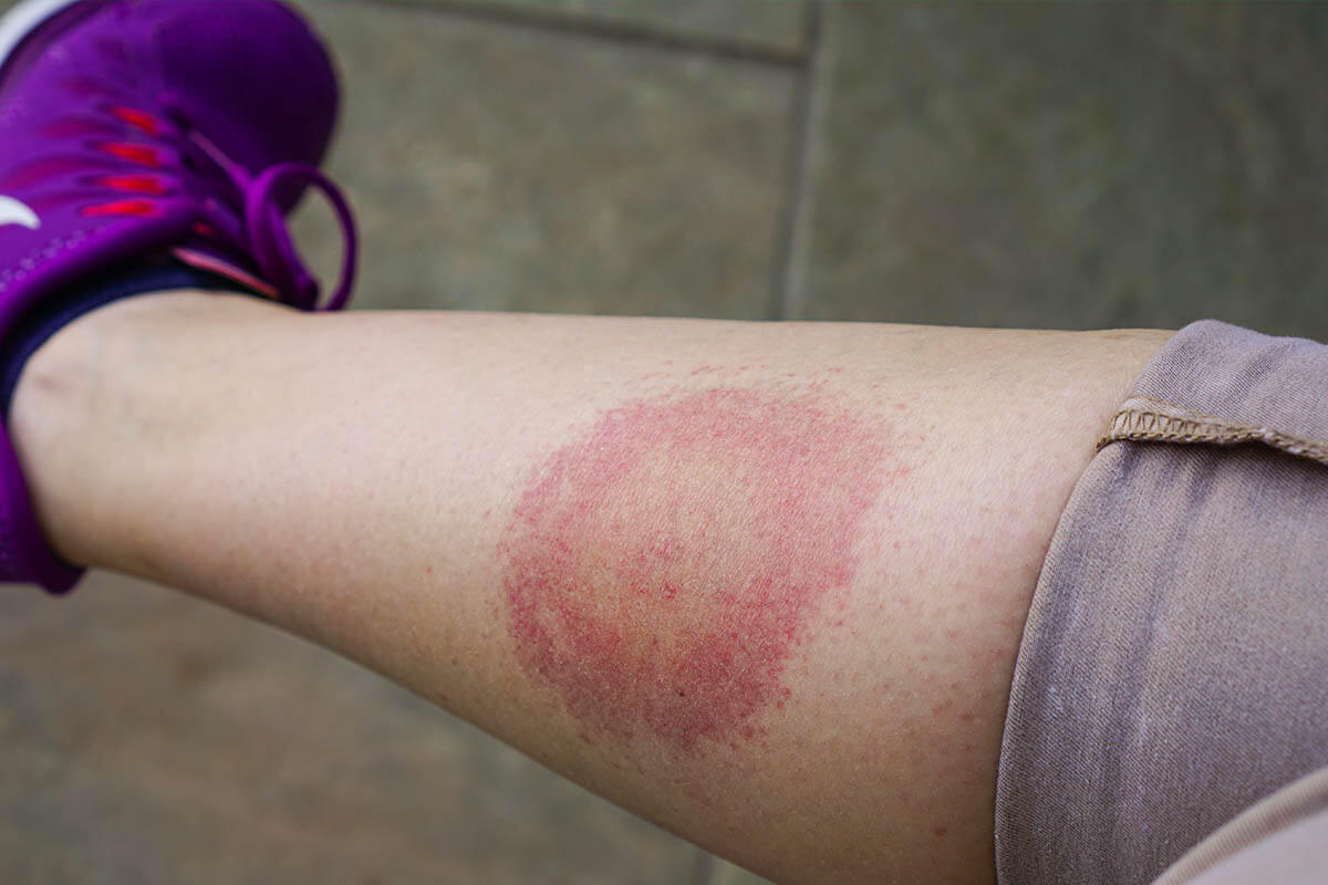 Hautveränderungen mit Fieber