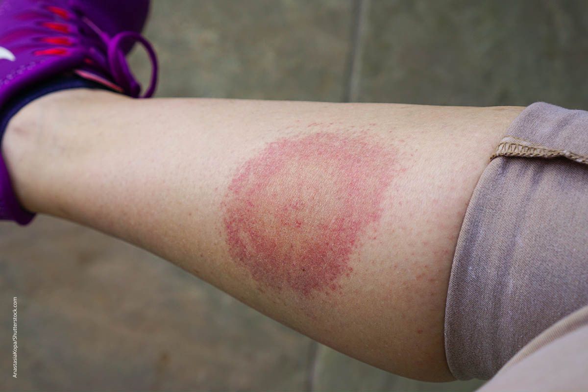 Kreisförmige Rötung an einem Unterschenkel. Die Wanderröte bei Borreliose geht meist ohne Fieber einher.