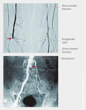 Periphere Arterielle Verschlusskrankheit Periphere Arterielle Verschlusskrankheit
