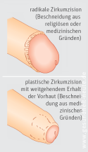 Nicht beschnitten mann